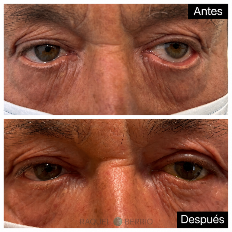 ectropion2-web-ok (Mediana)